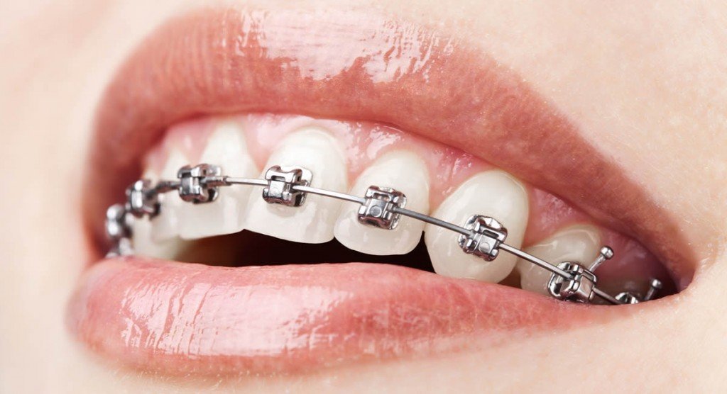 Braces2 Braces2