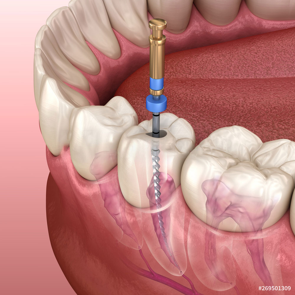 Root canal Root canal
