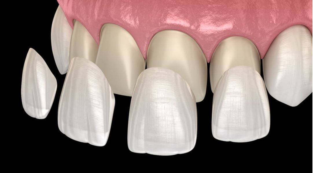 Veneers Veneers